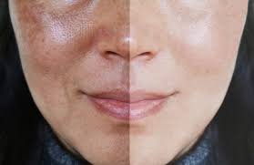 Dull look / Uneven tone Treatment Clinic