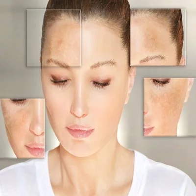 Hyperpigmentation treatment, Treatment for skin pigmentation, Pigmentation removal treatment, Best treatment for hyperpigmentation, Hyperpigmentation dermatologist, Skin discoloration treatment