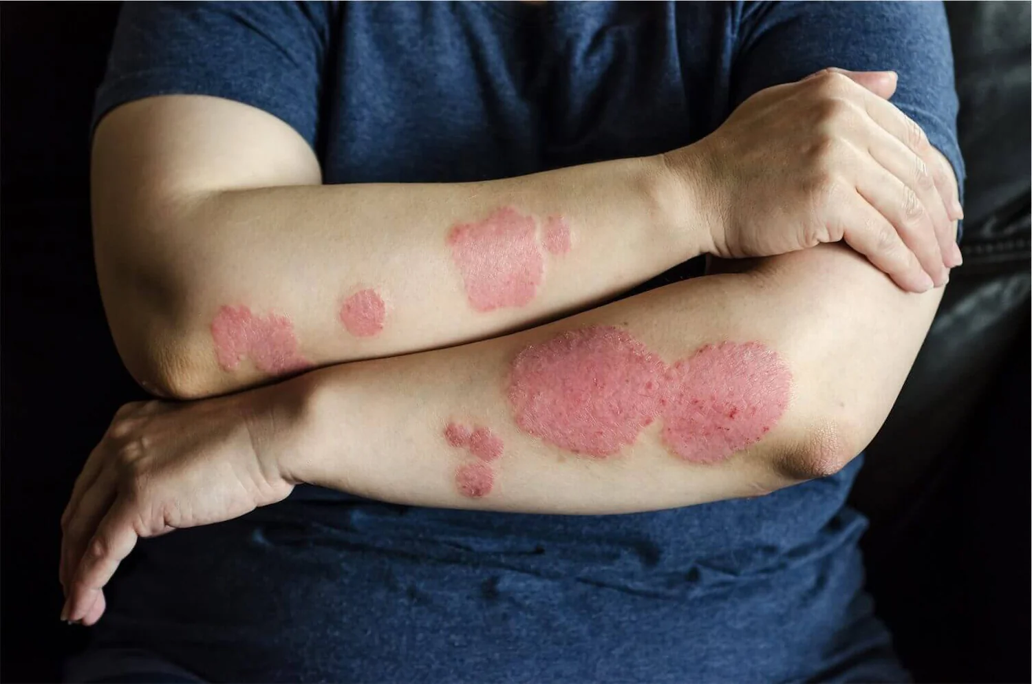 Psoriasis Treatment, Psoriasis Treatment by Dermatologist, Best Psoriasis Treatment, Skin Clinic for Psoriasis, Medical Treatment for Psoriasis, Psoriasis Management