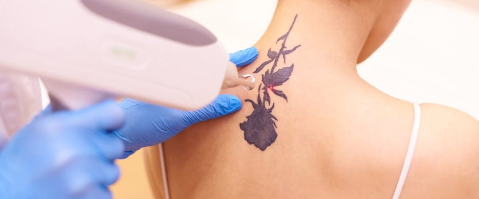 Tattoo removal treatment, Laser tattoo removal, Best tattoo removal clinic, Safe tattoo removal, Affordable tattoo removal, Permanent tattoo removal, Tattoo removal by experts, Advanced tattoo removal technology, Non-surgical tattoo removal, Tattoo removal for all skin types