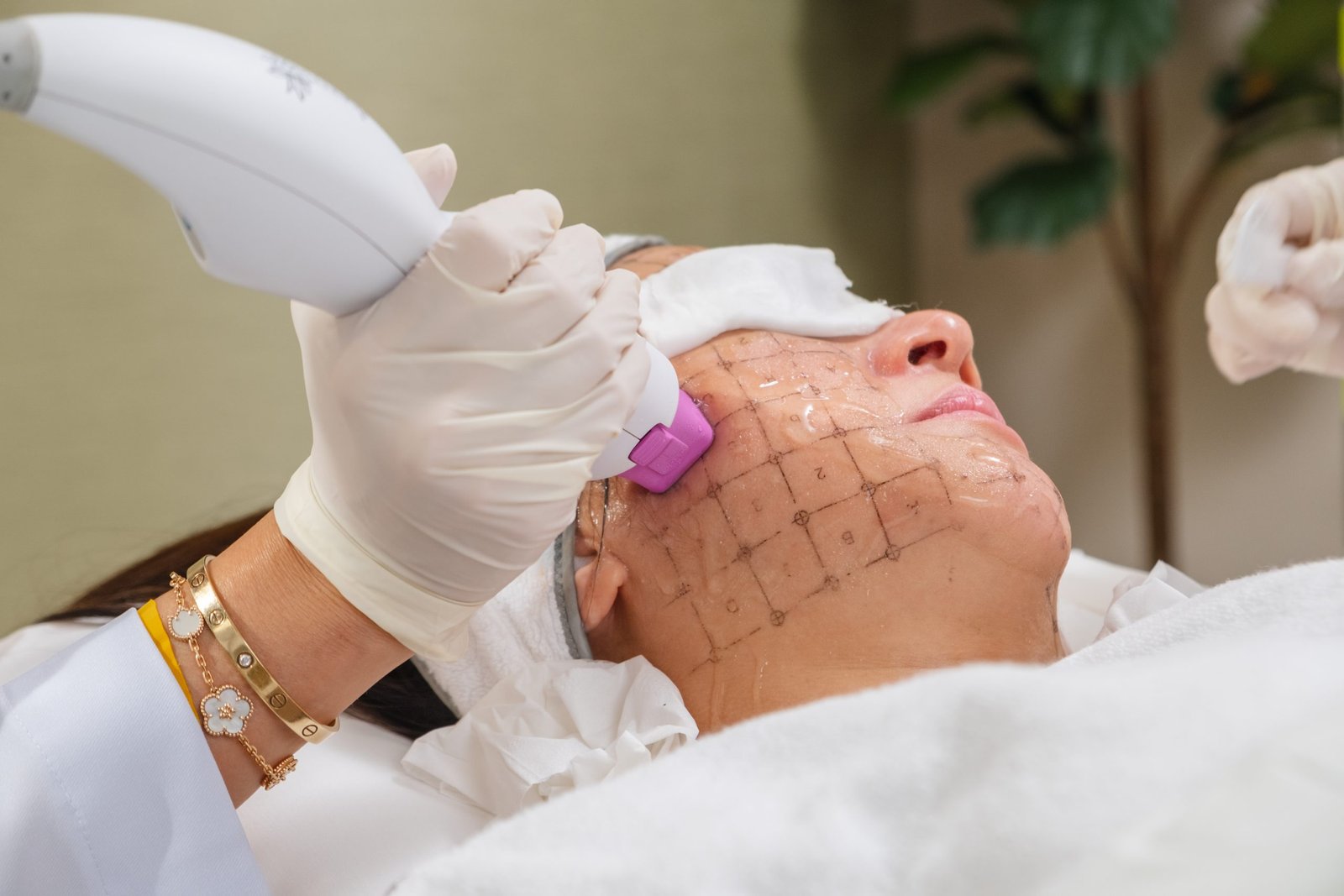 Thermage treatment, Thermage skin tightening, Non-surgical facelift with Thermage, Thermage face lift treatment, Thermage for wrinkles, Thermage for sagging skin