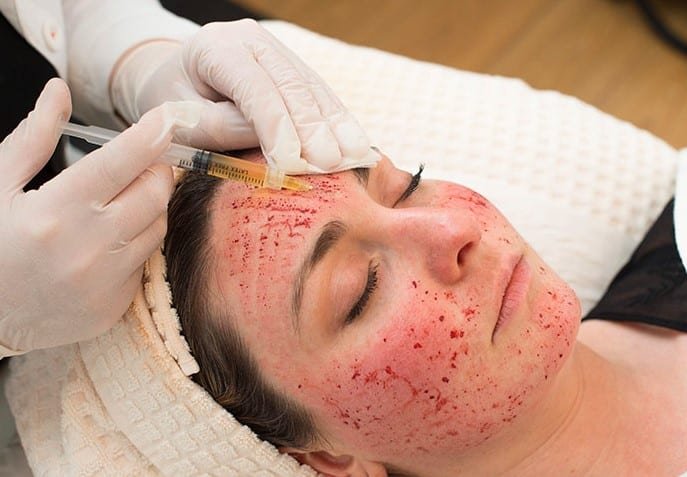 Vampire facial treatment, PRP facial treatment, Platelet-rich plasma facial, Vampire facelift, Skin rejuvenation vampire facial, PRP skin therapy