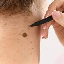 Effective Birthmarks Treatment – Advanced Solutions, Birthmarks treatment, Effective birthmark removal, Birthmark removal clinic,
