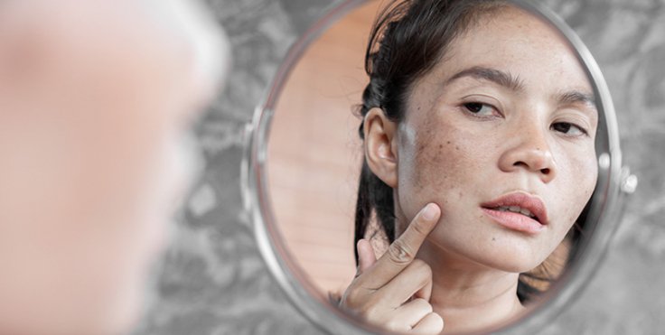 Melasma treatment, Hyperpigmentation treatment, Melasma removal therapy, Skin pigmentation treatment, , Best treatment for melasma, Melasma pigmentation solution