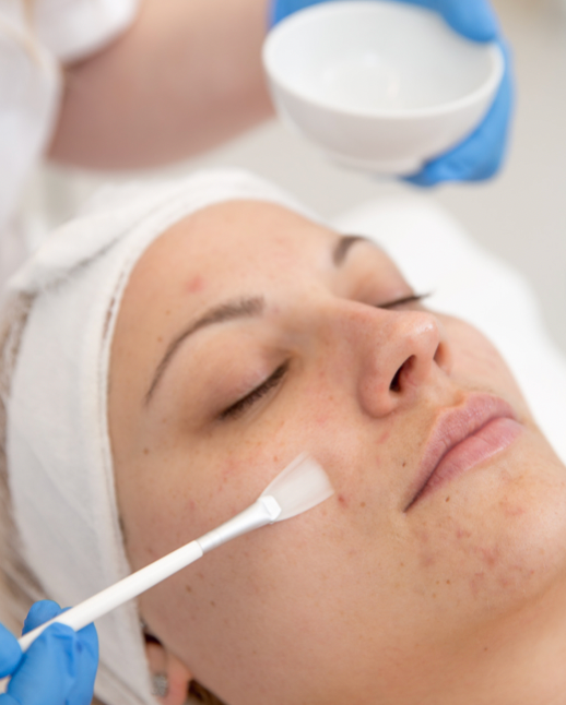 Mandelic acid peel treatment, Mandelic acid chemical peel, Mandelic peel for acne, Mandelic peel for pigmentation, Mandelic acid facial peel, Best mandelic acid peel clinic