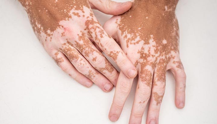 Vitiligo Treatment, Vitiligo Skin Treatment, White Patch Treatment, Treatment for Vitiligo Disease, Medical Treatment for Vitiligo, Vitiligo Dermatologist, Vitiligo Cure Options